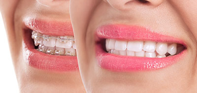 Cuddy Family Dentistry | Dental Sealants, Dental Bridges and Crowns