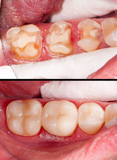 Cuddy Family Dentistry | All-on-6 reg , Digital Radiography and Night Guards