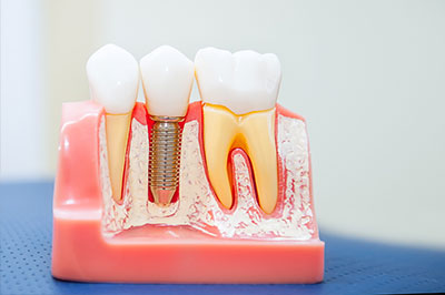 Cuddy Family Dentistry | Fluoride Treatment, Periodontal Treatment and Implant Dentistry