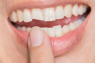 Cuddy Family Dentistry | Night Guards, Dental Fillings and Extractions