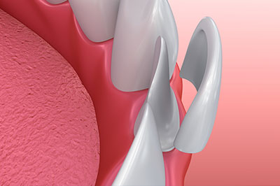 Cuddy Family Dentistry | Extractions, Digital Radiography and ZOOM  Whitening