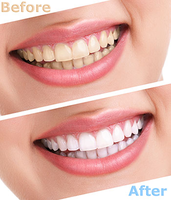 Cuddy Family Dentistry | Veneers, All-on-6 reg  and Oral Exams