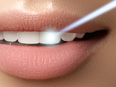 Cuddy Family Dentistry | Teeth Whitening, Inlays  amp  Onlays and Oral Exams